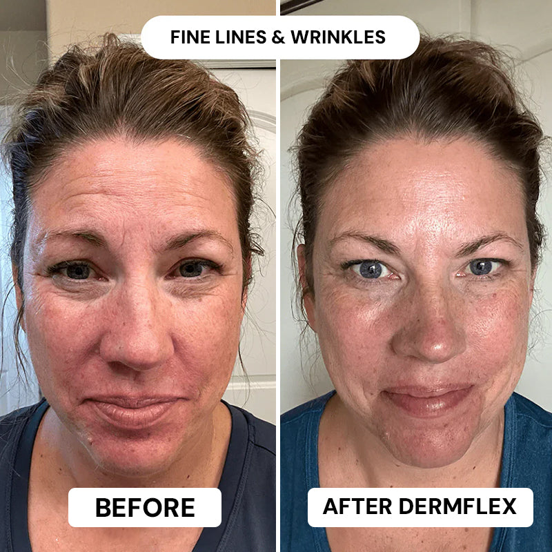 DermFlex - Wrinkle Eraser