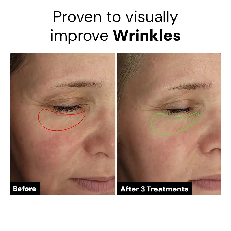 Micro Infusion Patches