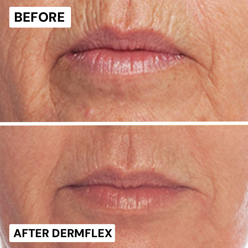 DermFlex - Wrinkle-Eraser